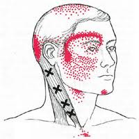 triggerpoints in de mm sterno-cleidomastoïdius kan zorgen voor hoofdpijn ( roodgemerkte gebieden)